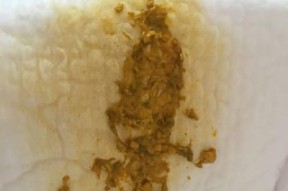 宝宝吃母乳拉稀正常吗？如何判断和处理？