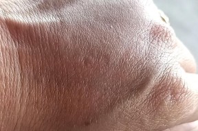 被蜜蜂蛰了怎么办？处理方法和预防措施是什么？
