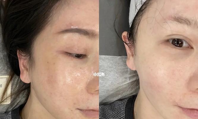 如何有效解决脸上毛孔粗大问题（15种方法让你拥有细腻无瑕的肌肤）  第1张