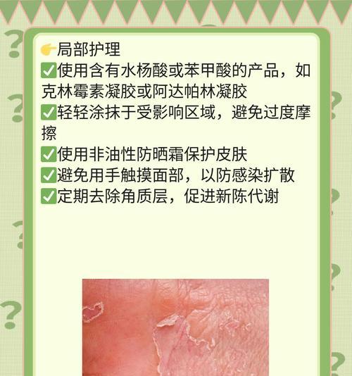 额头痘痘怎么快速去除？有效家庭疗法有哪些？  第2张